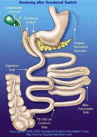 Duodenal Switch Pre-Op Diet