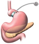 Picture of Lap Band Gastric Bypass