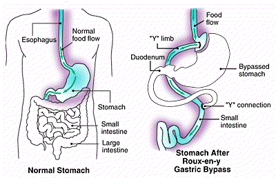 Picture of RNY Gastric Bypass